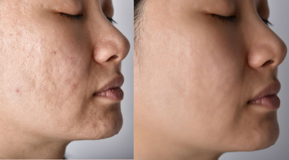 acne scars treatment subcision